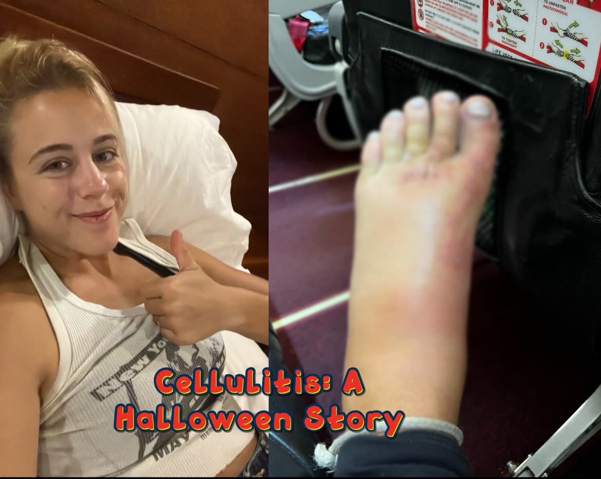 My Gruesome Tale of Cellulitis: A Coral Cut Horror Story (with Photos!)